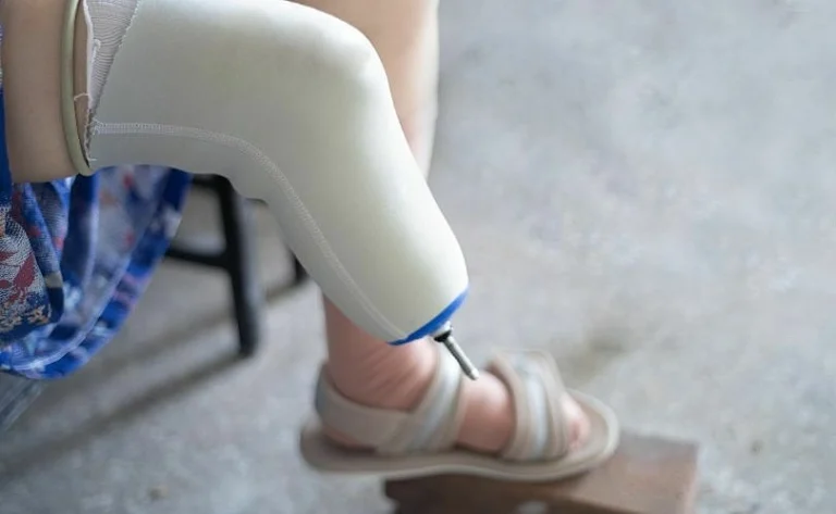 NeuRA launches world’s largest clinical trial for phantom limb pain